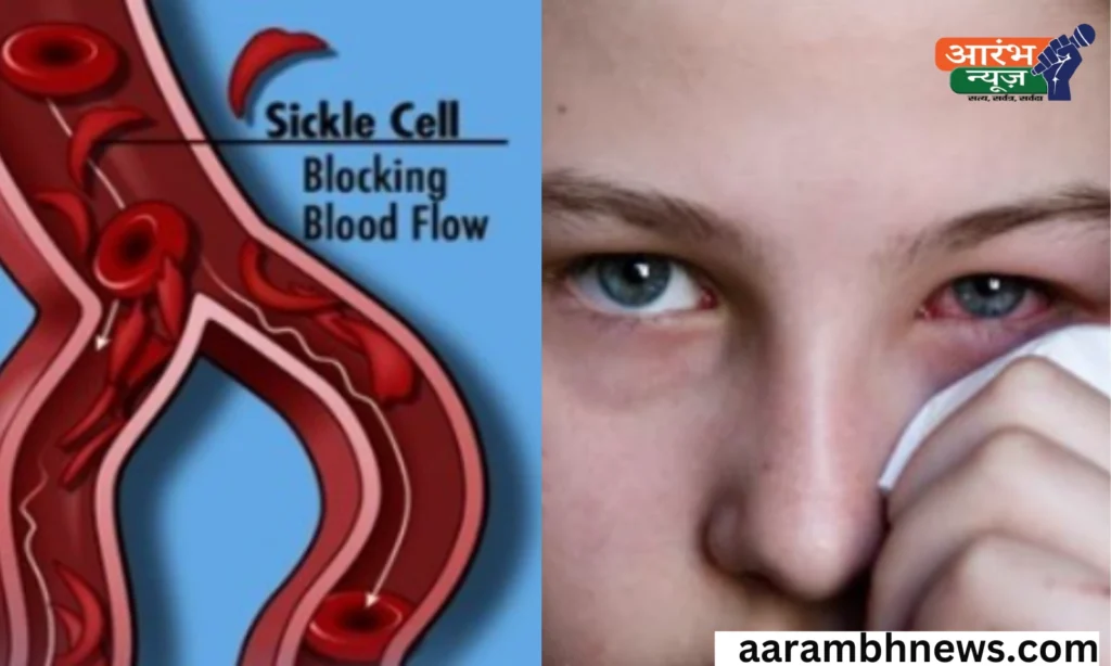 World Sickle Cell Day 2025: जेनेटिक लड़ाई, जागरूकता बढ़ाई, जानकारी ही बचाव है 1 World Sickle Cell Day 2025