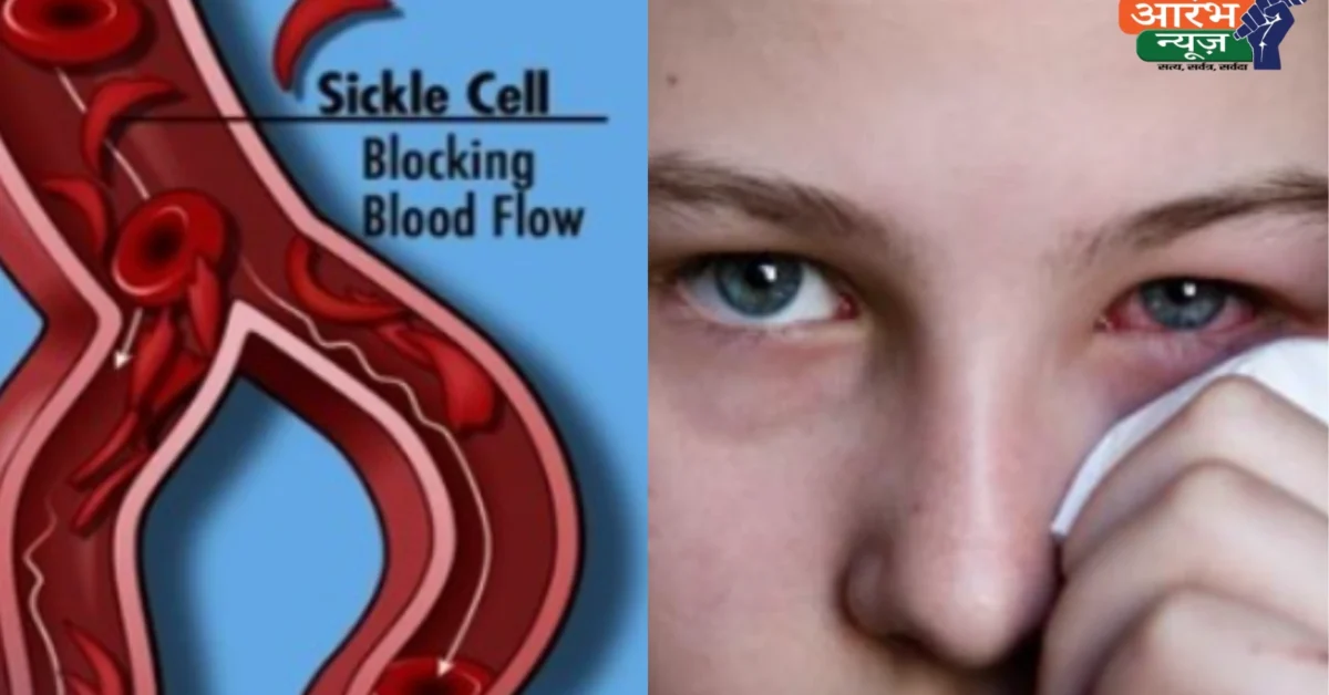World Sickle Cell Day 2025