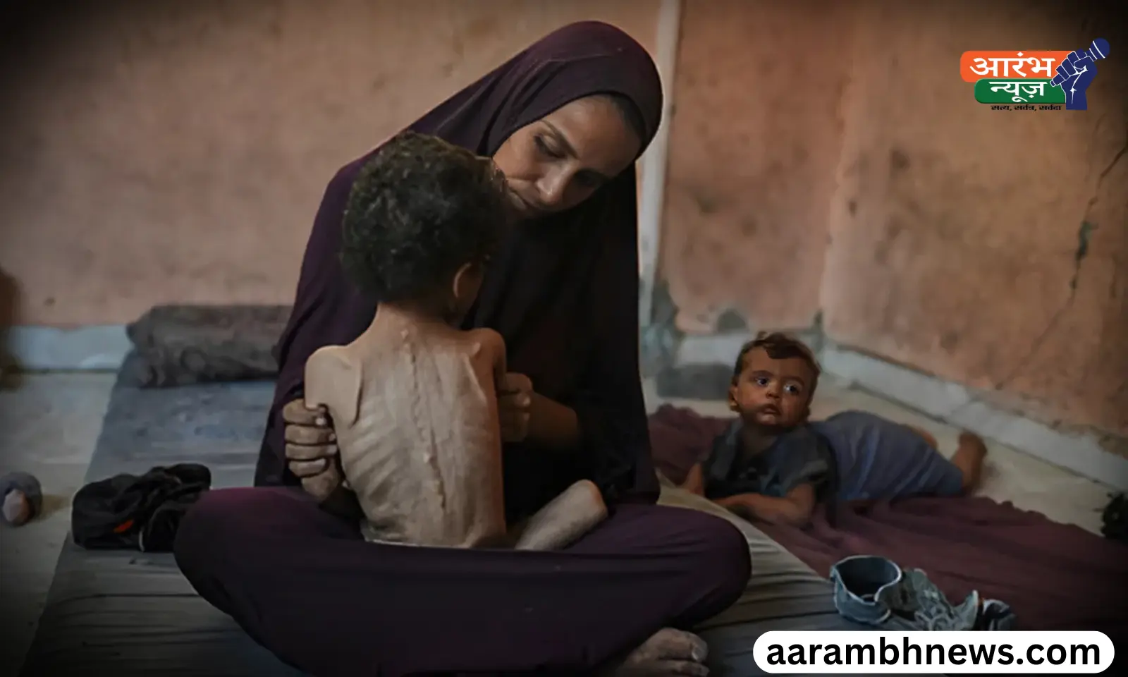Gaza children malnutrition भूख से तड़पते मासूम, डॉक्टर बोले - ये बच्चे शायद कभी ठीक न हो पाएं
