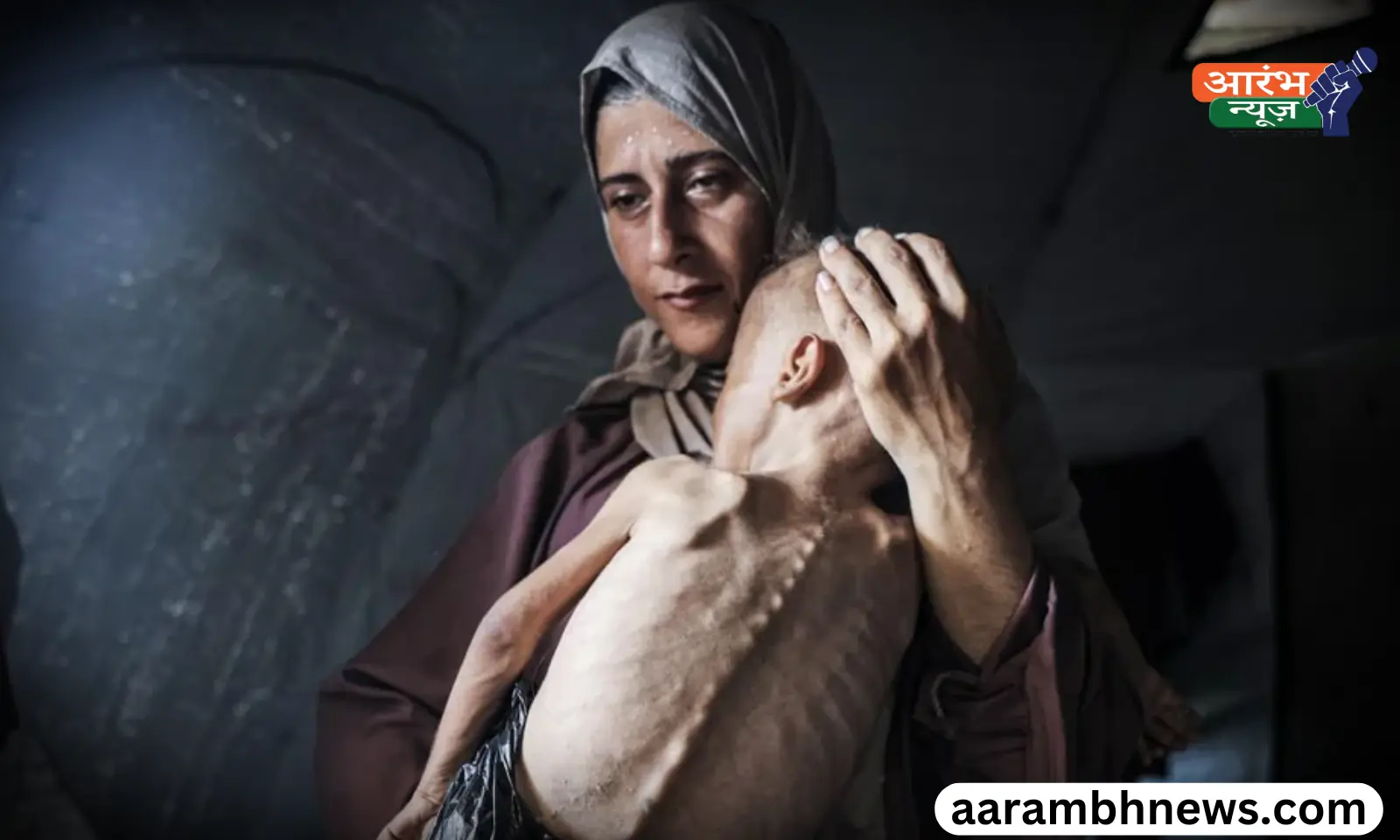 Gaza children malnutrition भूख से तड़पते मासूम, डॉक्टर बोले - ये बच्चे शायद कभी ठीक न हो पाएं
