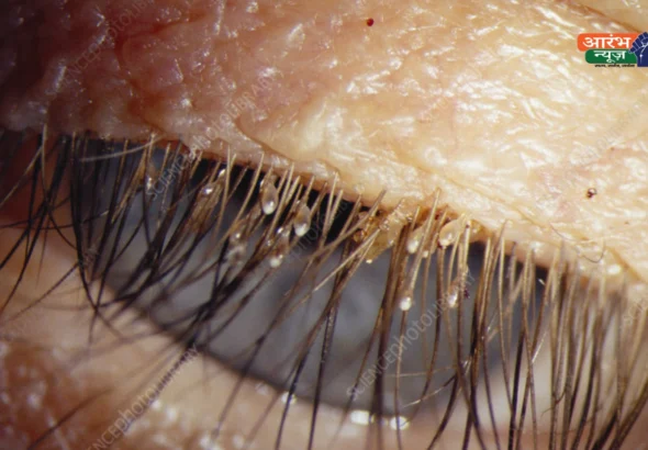Eyelash lice case