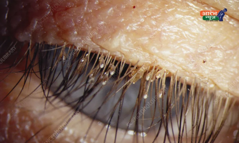 Eyelash lice case