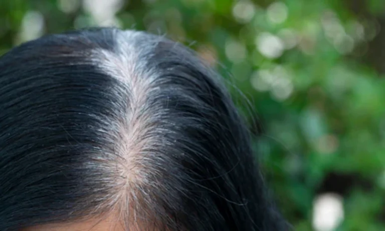 premature white hair