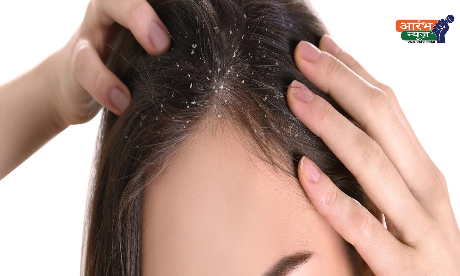 winter dandruff tips