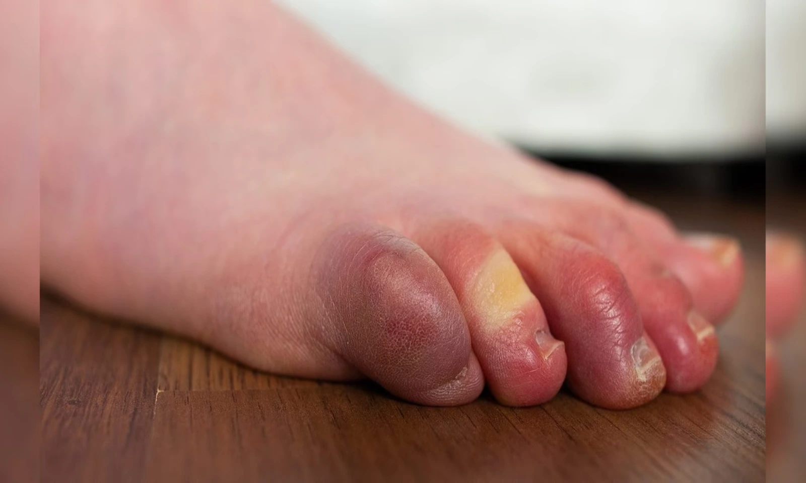 Finger swelling in winter