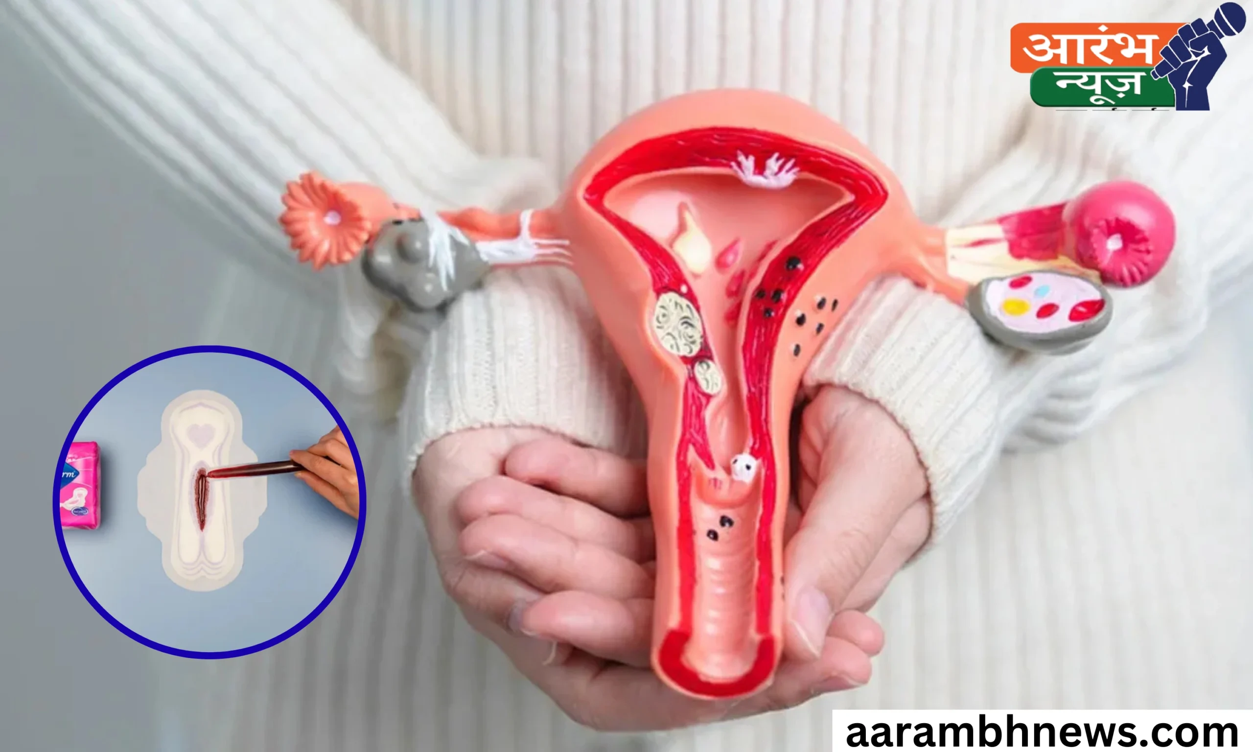 Uterine Fibroids